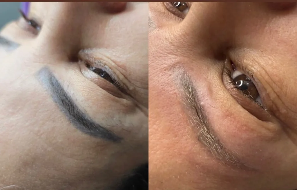 Antes e depois de despigmentação clareamento de micropigmentação antiga